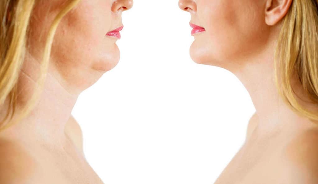 Double Chin treatment Chorleywood before and after results