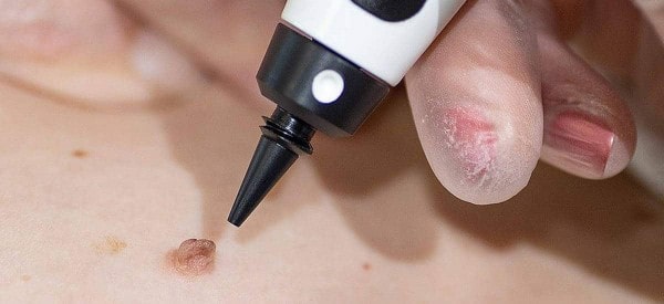 After Skin Tag Removal Chorleywood