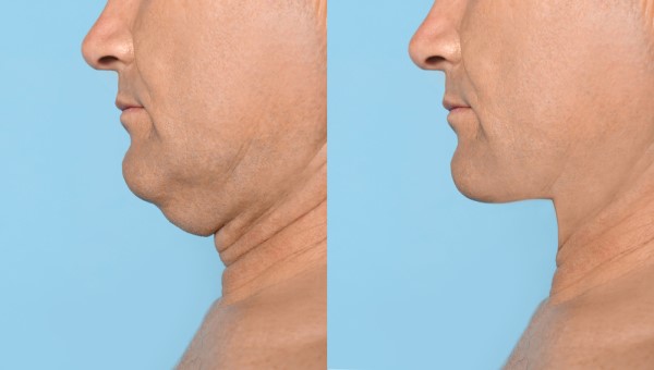 Which Non-Surgical Treatments Work Best for Jowls and Loose Skin Chorleywood?