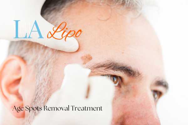 What Are the Most Effective Treatments for Age Spots Chorleywood?