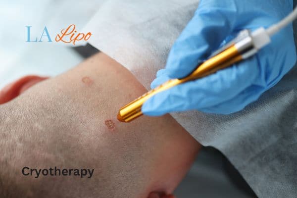 cryotherapy for warts