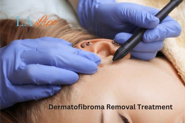 Dermatofibroma Removal Treatment Chorleywood