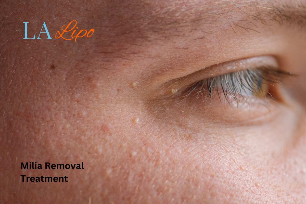 Cryopen Milia Removal: Is It the Easiest and Safest Option Chorleywood?