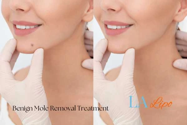 woman's before and after mole removal Chorleywood results