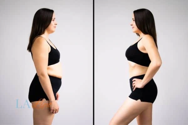 image of woman before and after results of LA-EMS Body Sculpting Chorleywood to help treat Diastasis recti