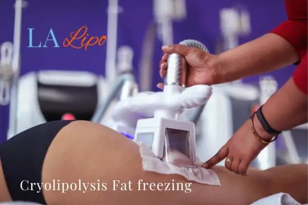 women getting fat freezing Chorleywood