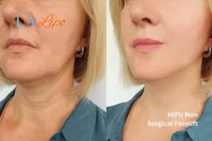hi-fu for wrinkles Chorleywood before and after results
