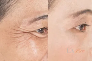 Before and after results of woman - HI-fu wrinkles reduction treatment Chorleywood