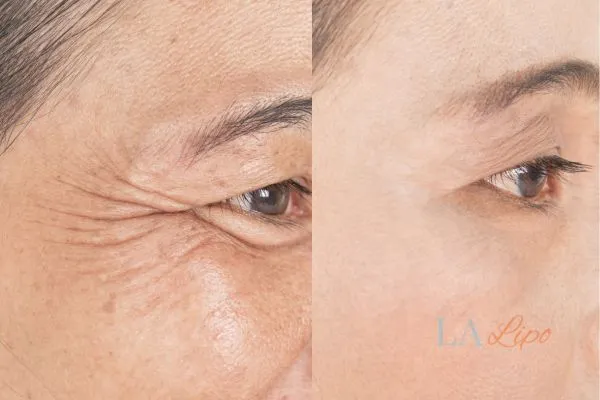 Before and after results of woman - HI-fu wrinkles reduction treatment Chorleywood