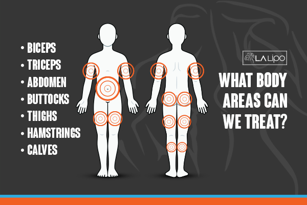 Graphic to show areas you can have LA-EMS Body Sculpting Chorleywood treatment.