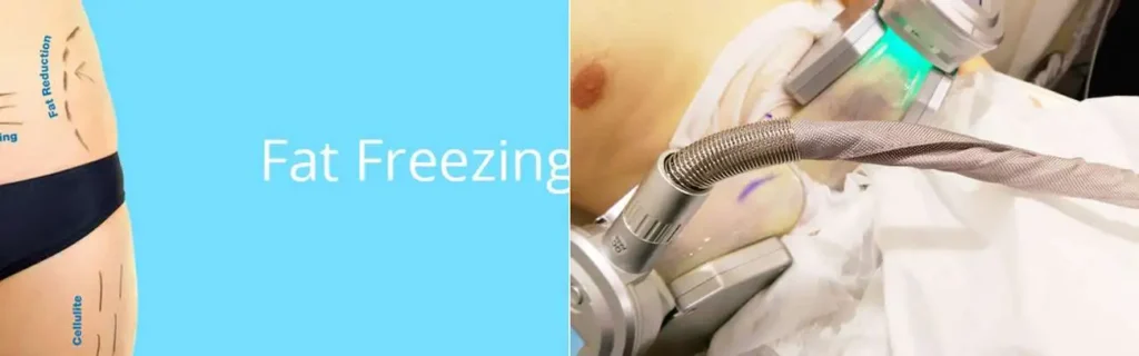 Fat freezing Chorleywood on multiple areas of the body
