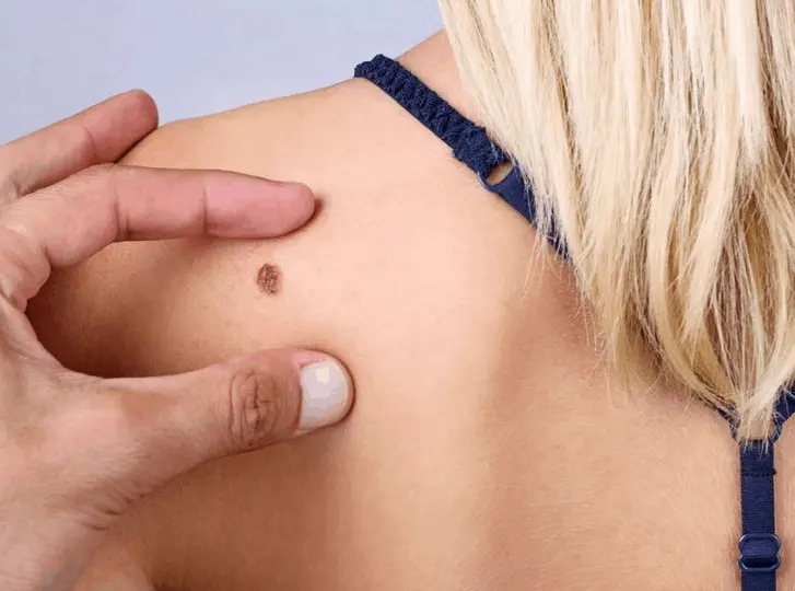woman having mole removal Chorleywood consultation before treatment.