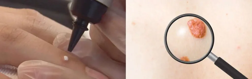 Cryopen for mole removal Chorleywood - speak to our team today!