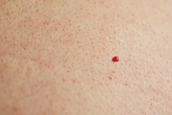 close up of a cherry angioma Chorleywood