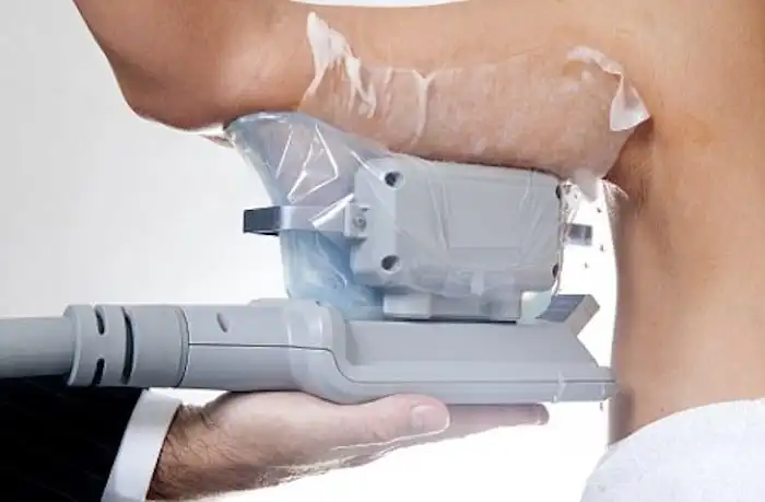 Picture of fat freezing Chorleywood on the upper arms.