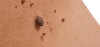 image of a skin tag Chorleywood