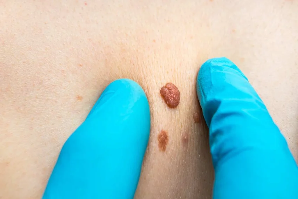 Consultant examining a skin tag Chorleywood