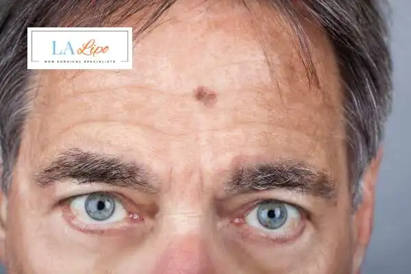 Solar Lentigo Removal Chorleywood image of man with mark on his forehead