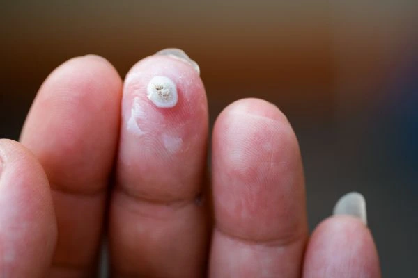 wart on person finger - cryotherapy to treat from LA LIPO Chorleywood