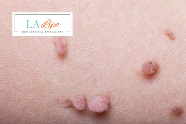 Does cryopen skin tag removal Chorleywood hurt? Find out now call our team today!