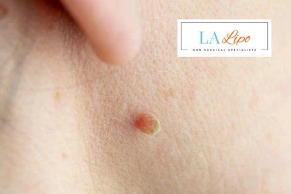 Book skin tag removal Chorleywood today speak to our team now!