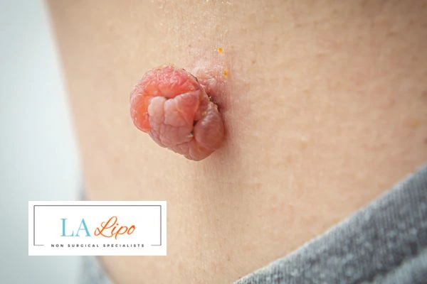 Interested in skin tag removal Chorleywood? Concerned about the pain? Find out more today!