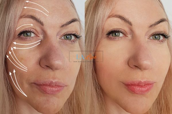 Morpheus 8 results Chorleywood face lift.