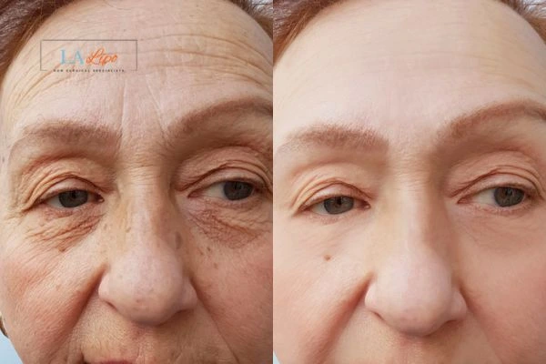 The powerful benefits of Morpheus8 Treatment Chorleywood - Call Our team today!