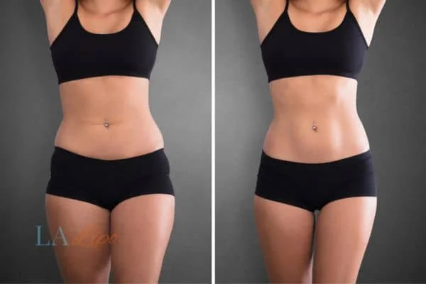 before and after results of non-surgical treatment to help a woman's body image and mental health Chorleywood