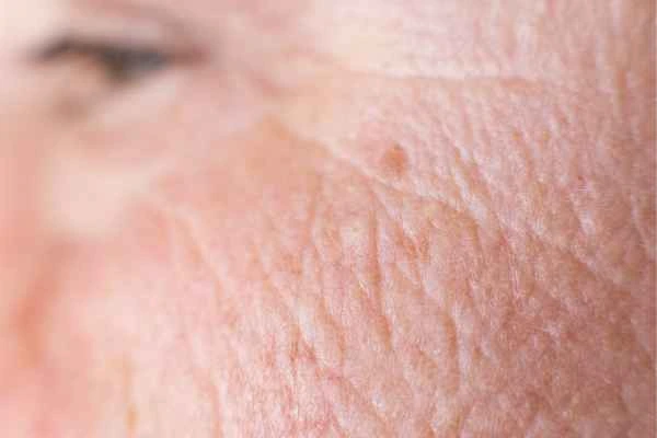 close up picture of a woman's face showing an age spot Chorleywood