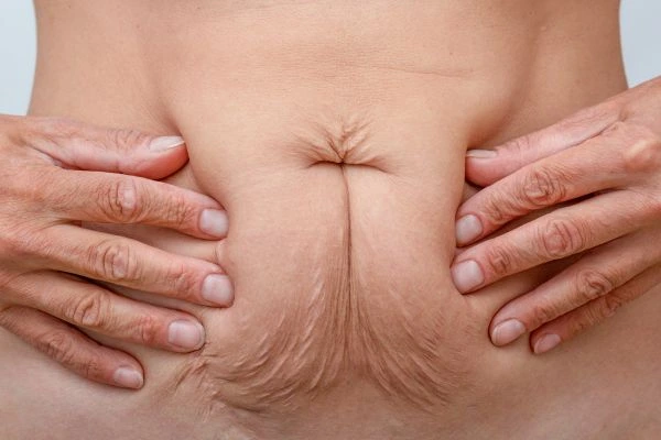 Image of a woman's stomach with loose skin - example of skin tightening Chorleywood options