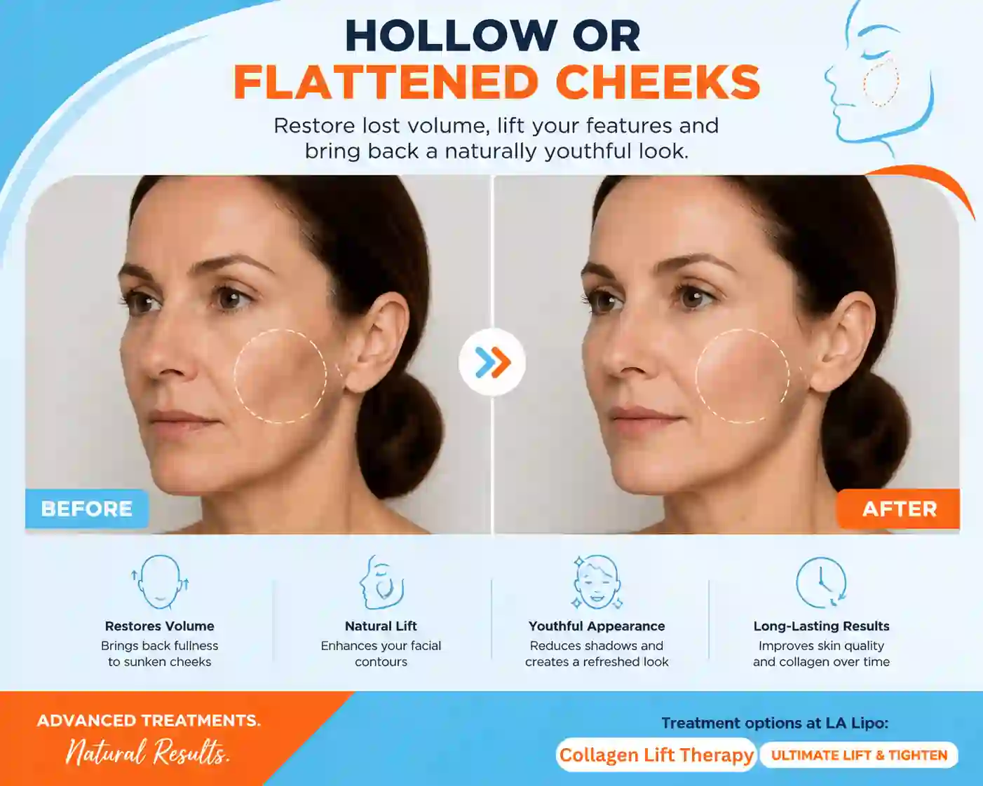 Sign #4: Hollow or Flattened Cheeks Chorleywood
