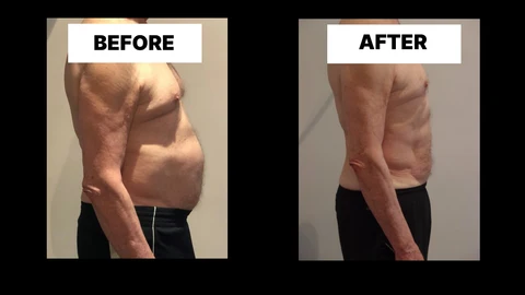 What Symptoms Can Diastasis Recti Cause in Men? Weak Core, Back Pain and Poor Posture Chorleywood